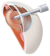 Cataract anatomy