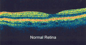 OCT of a normal retina